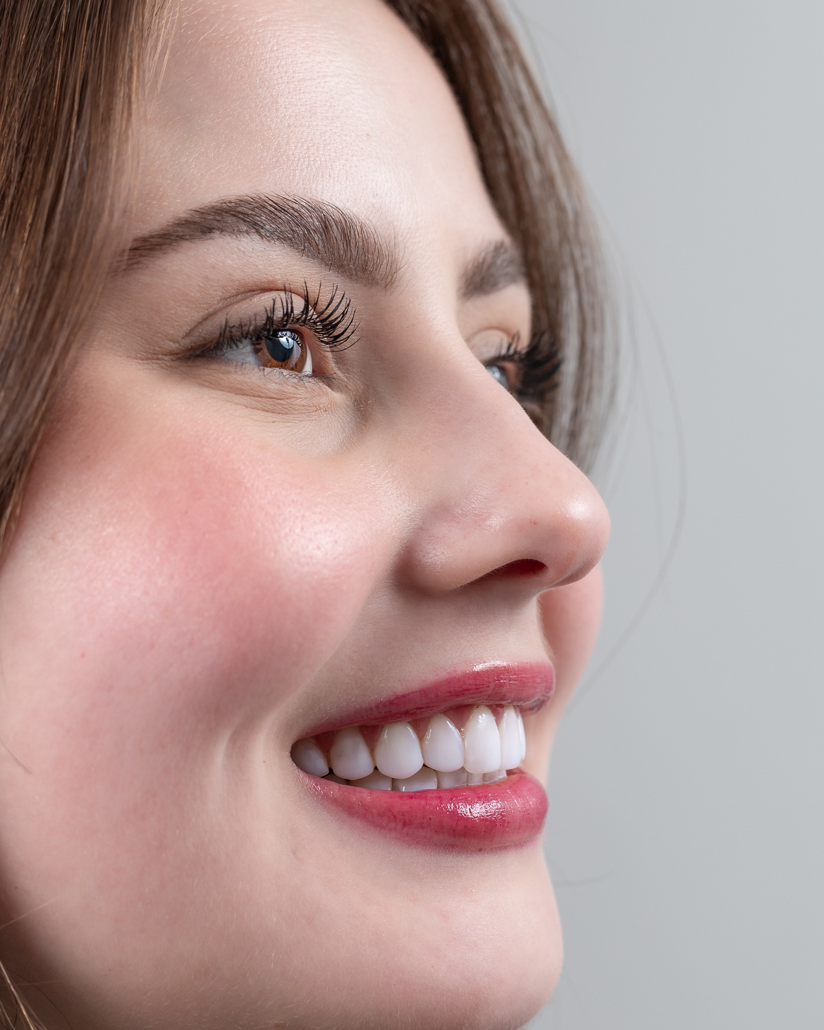 Imagem da transformação do sorriso com resina composta, sem desgastes dos dentes naturais. 