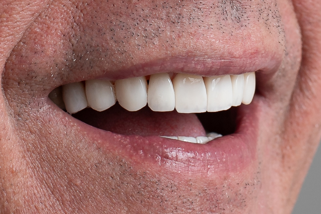 Imagem da transformação do sorriso com resina composta sem desgastes dos dentes originais. O resultado são dentes perfeitos e com cor natural.