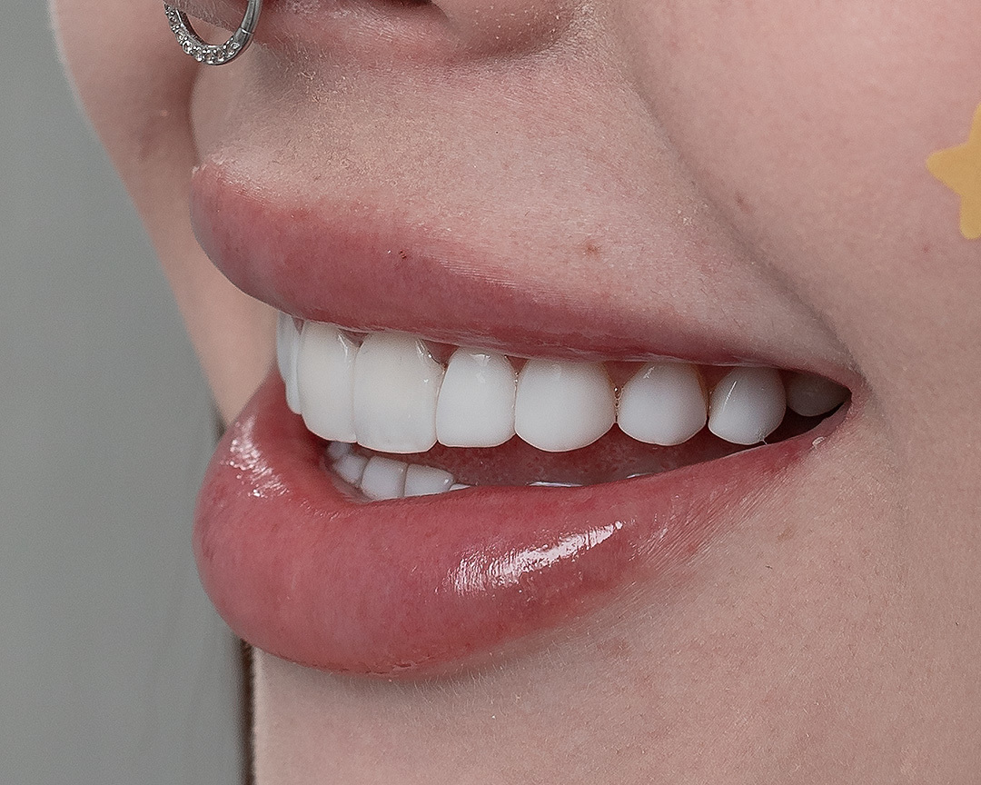 Quer um sorriso que te represente? A resina composta é a solução perfeita para você! Veja como essa técnica pode corrigir imperfeições, clarear os dentes e te proporcionar um sorriso mais harmônico. Agende sua consulta e mude sua vida!