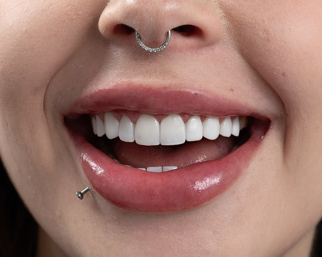 Quer um sorriso que te represente? A resina composta é a solução perfeita para você! Veja como essa técnica pode corrigir imperfeições, clarear os dentes e te proporcionar um sorriso mais harmônico. Agende sua consulta e mude sua vida!