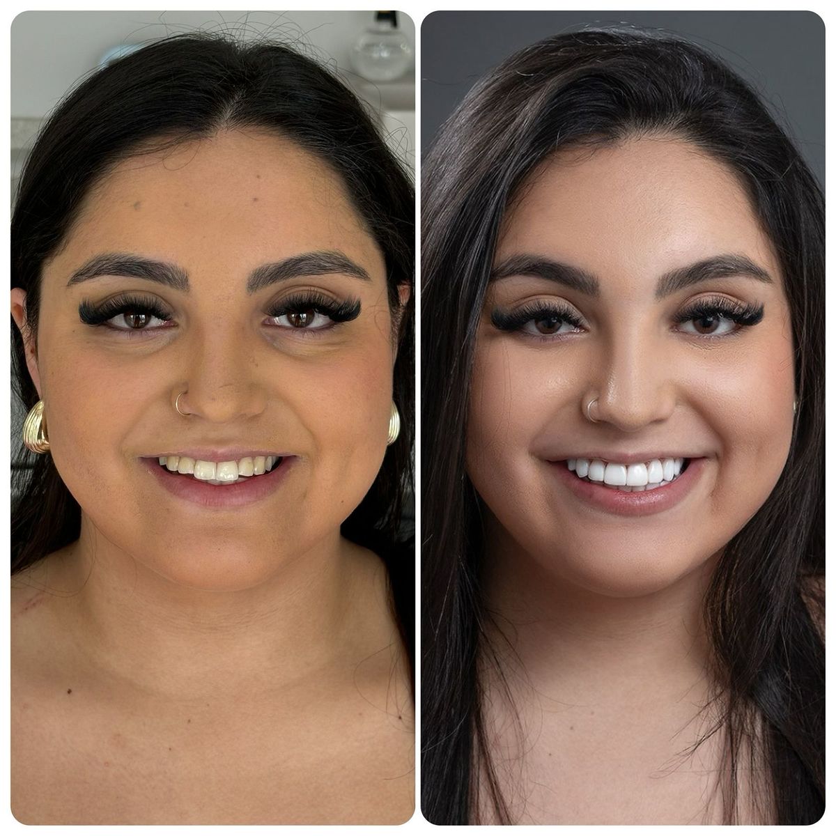 Facetas em resina composta sem desgaste dos dentes naturais e respeitando a anatomia dos dentes. Alla Vita Odontologia transforma e cuida do seu sorriso.