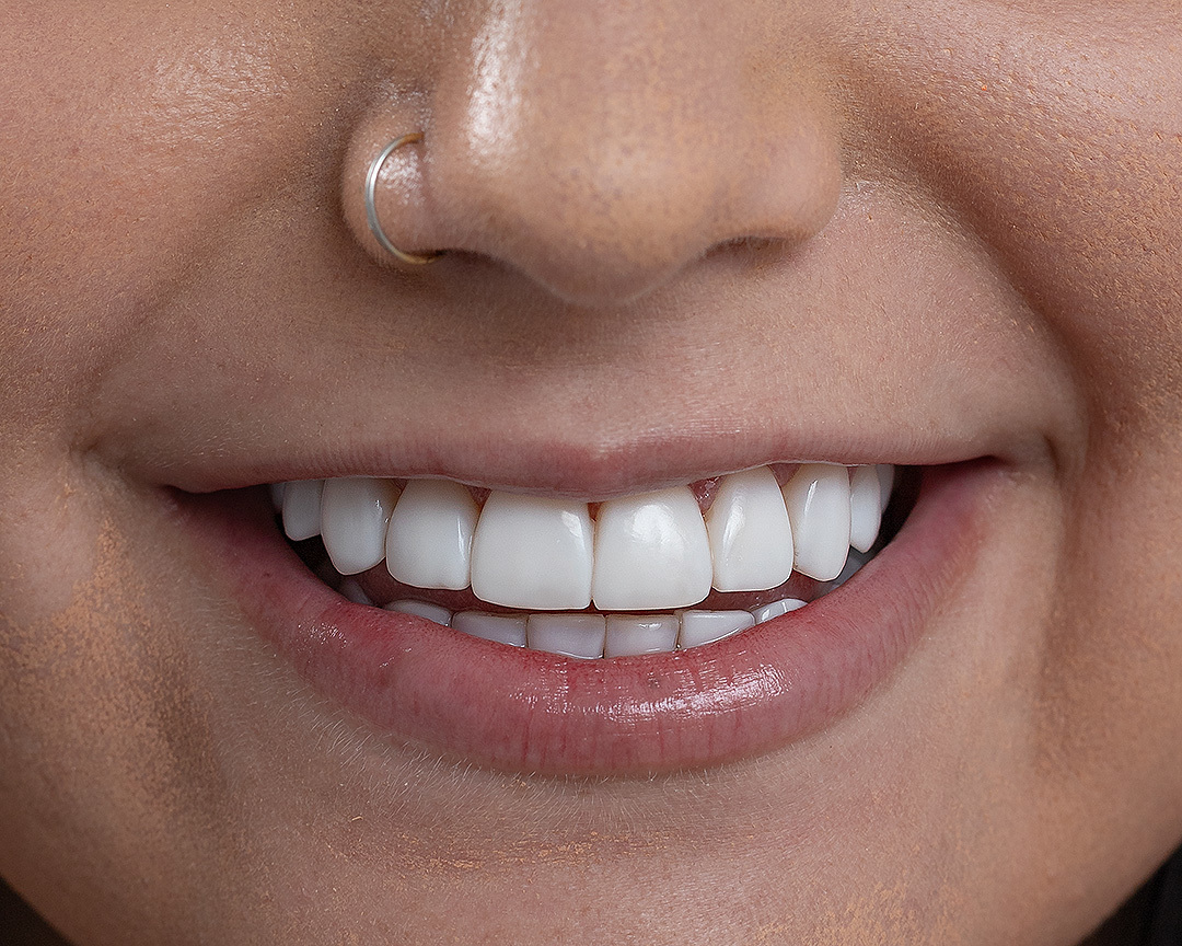 respeitando a anatomia dos dentes. Alla Vita Odontologia transforma e cuida do seu sorriso.