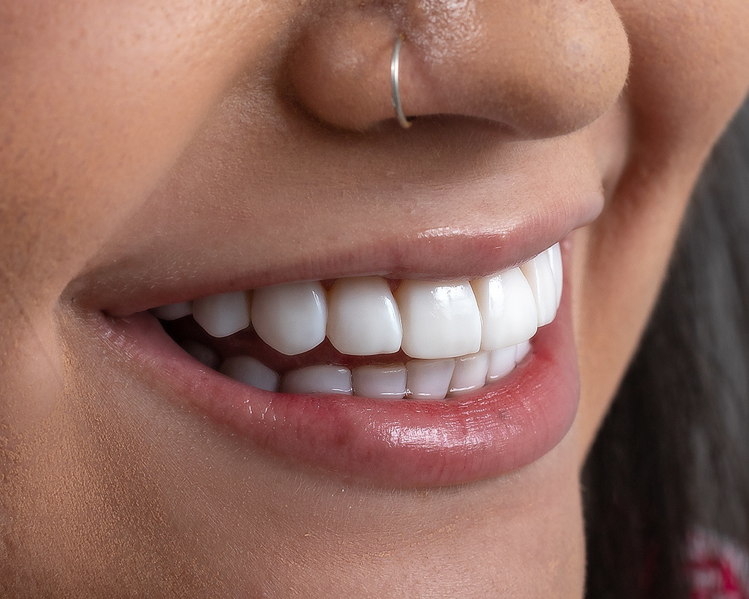 respeitando a anatomia dos dentes. Alla Vita Odontologia transforma e cuida do seu sorriso.