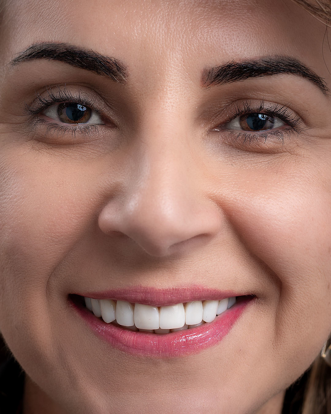 Imagem da transformação do sorriso com resina composta, sem desgastes dos dentes naturais. 