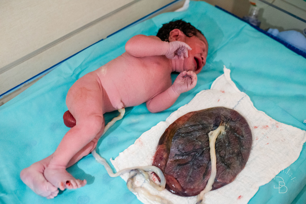 placenta do bebê junto do cordão umbilical